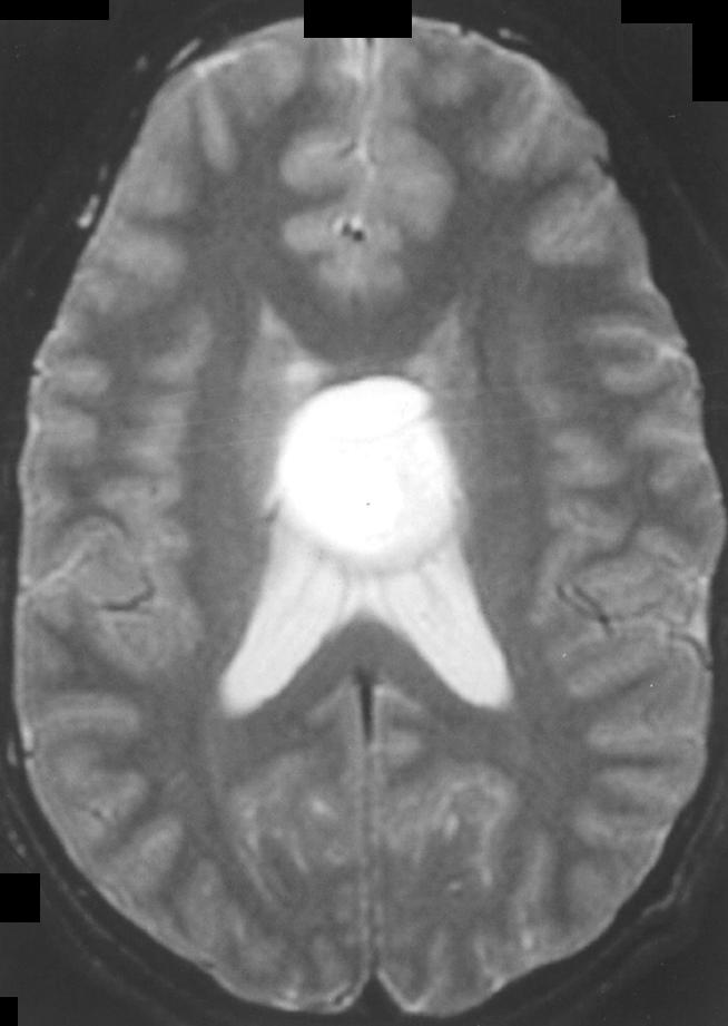 The solid portion of the tumor usually enhances, in contrast to most low-grade infiltrative astrocytomas, which tend not to enhance [4] (Fig. 4).