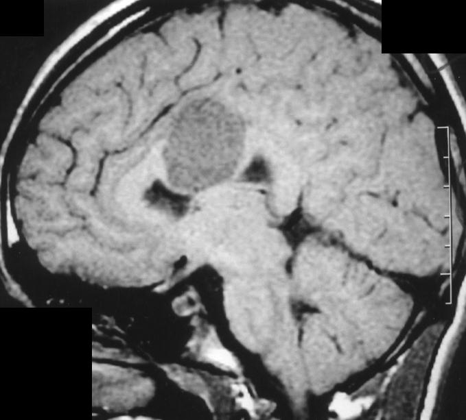 Lesions characteristically involve the periventricular white matter, internal capsule, corpus callosum, and pons, although plaques can be found