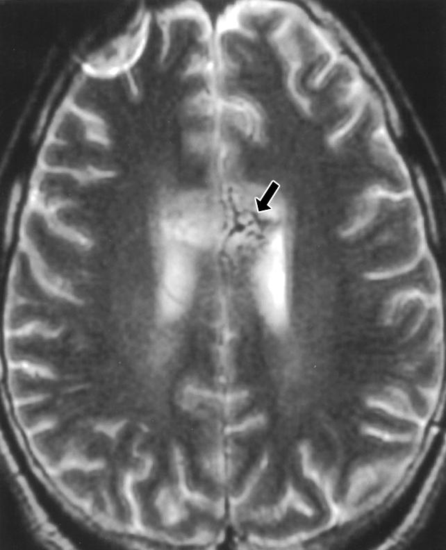 ourekas et al. and frequently with evidence of intraventricular hemorrhage [9] (Fig. 9). Downloaded from www.ajronline.org by 37.44.199.34 on 02/07/18 from IP address 37.