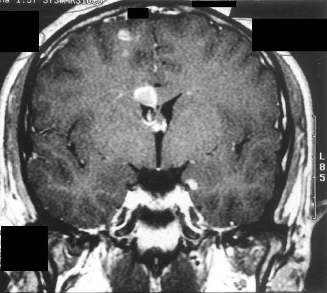 The callosal lesions most commonly involve the splenium, are usually eccentric in location, and can involve a focal part or the full thickness of the corpus callosum.