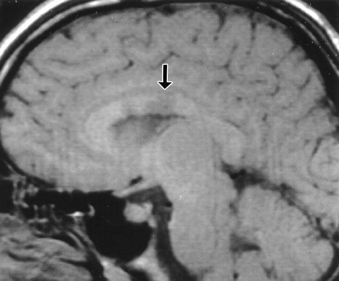 , Sagittal T1-weighted MR image shows hemorrhage (arrows) and multiple flow voids in corpus callosum.
