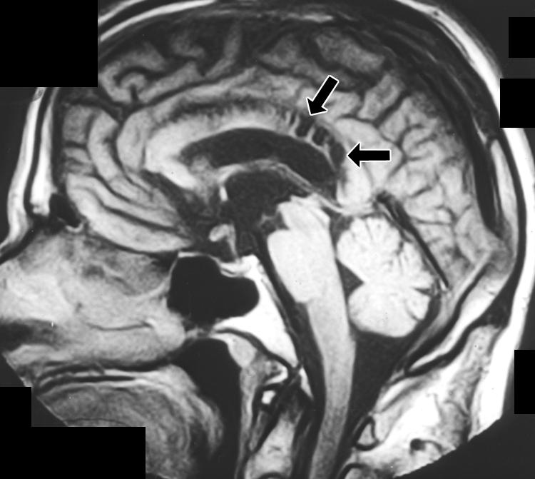 Patient is asymptomatic other than for headaches, which are probably due to mild hydrocephalus., Sagittal T1-weighted MR image shows well-defined cystic lesions (arrows) of corpus callosum.