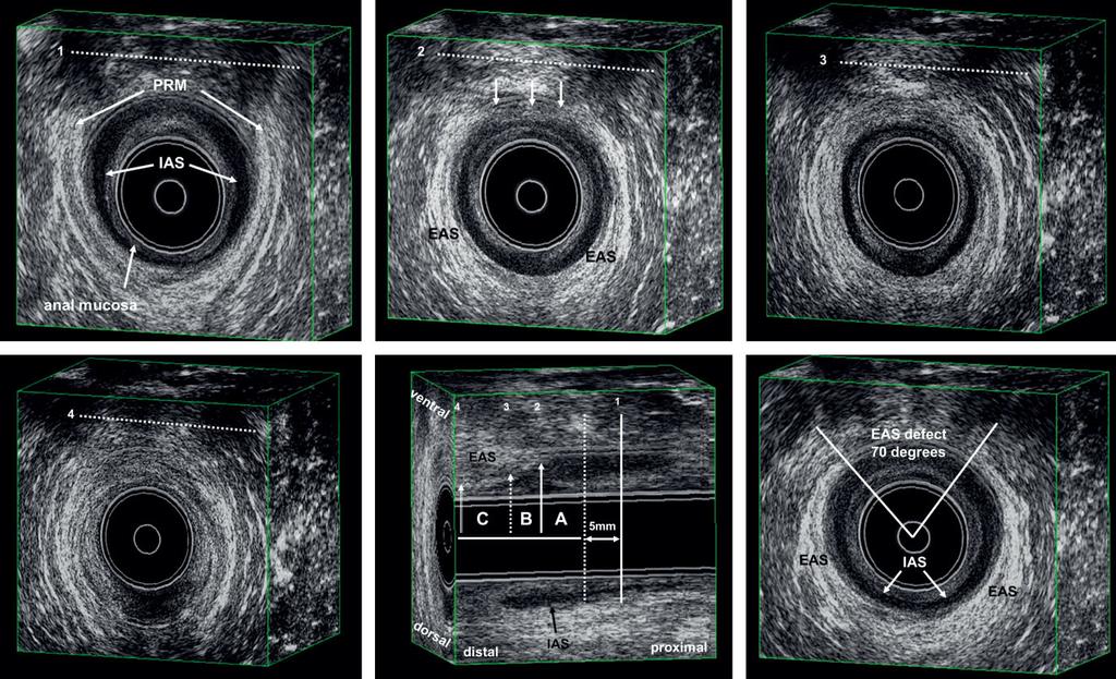 210 Norderval et al. Figure 1 Three-dimensional (3D) endoanal ultrasound (EAUS) images showing assessment of the EAUS defect score.