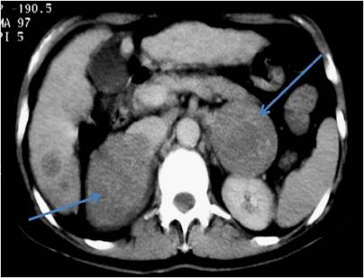 lesion in both liver lobes with minimal enhancement on arterial phase (arrows). Figure 4.