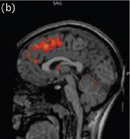 Neuroimaging (brain