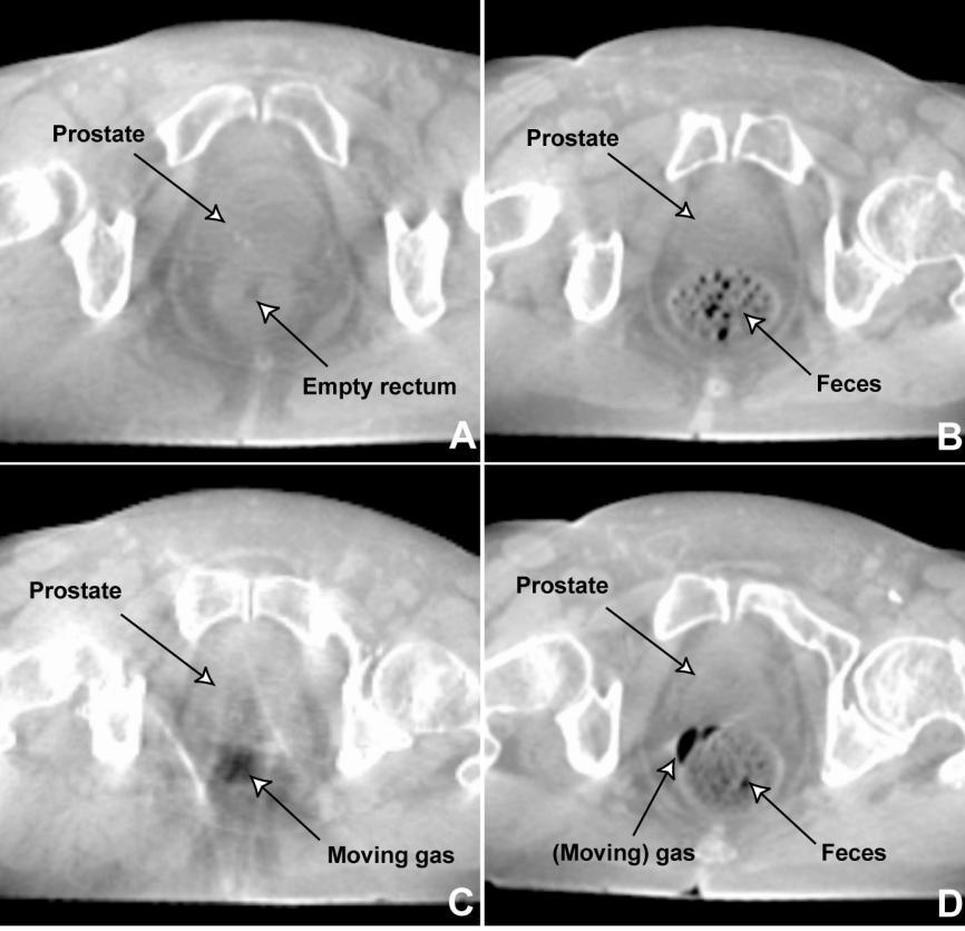 82 - Chapter 4 INCIDENCE OF FECES, GAS, AND MOVING GAS The incidence of feces and (moving) gas in the CBCT scans at the level of the prostate was visually assessed and scored by an observer (FIGURE