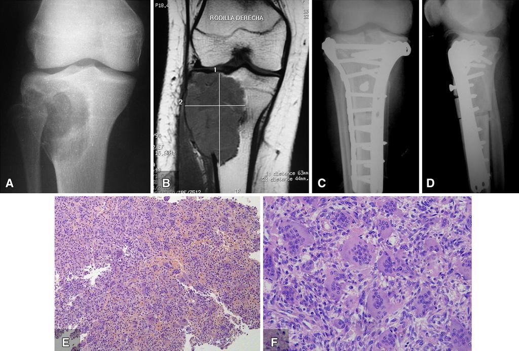 Volume 473, Number 9, September 2015 Sarcoma Arising in Giant Cell Tumor With Denosumab 3051 an incidence ranging from 1.4% to 6.
