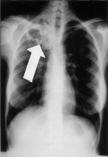 Chest Radiograph Chest X-ray