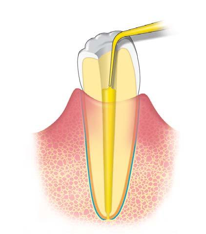 Deciduous Teeth Insert the syringe tip near the apex. Express Vitapex into the canal until it reverses back into the pulp chamber.
