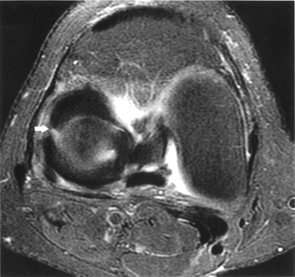 sagittal). The sequences were obtained with a 4-mm slice thickness in 43 patients and with a 5-mm slice thickness in 19 patients because it was a retrospective review.