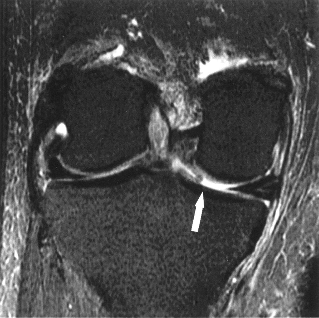 MRI of Meniscal Tears Fig. 2. 62-year-old man with bucket-handle tear of medial meniscus.