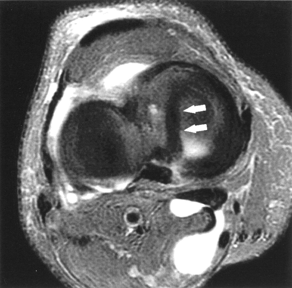 component (arrows) extending from anterior to posterior., ucket-handle tear (arrow) is shown on coronal fat-saturated fast spin-echo proton density weighted image (3,267/60; slice thickness, 4 mm).