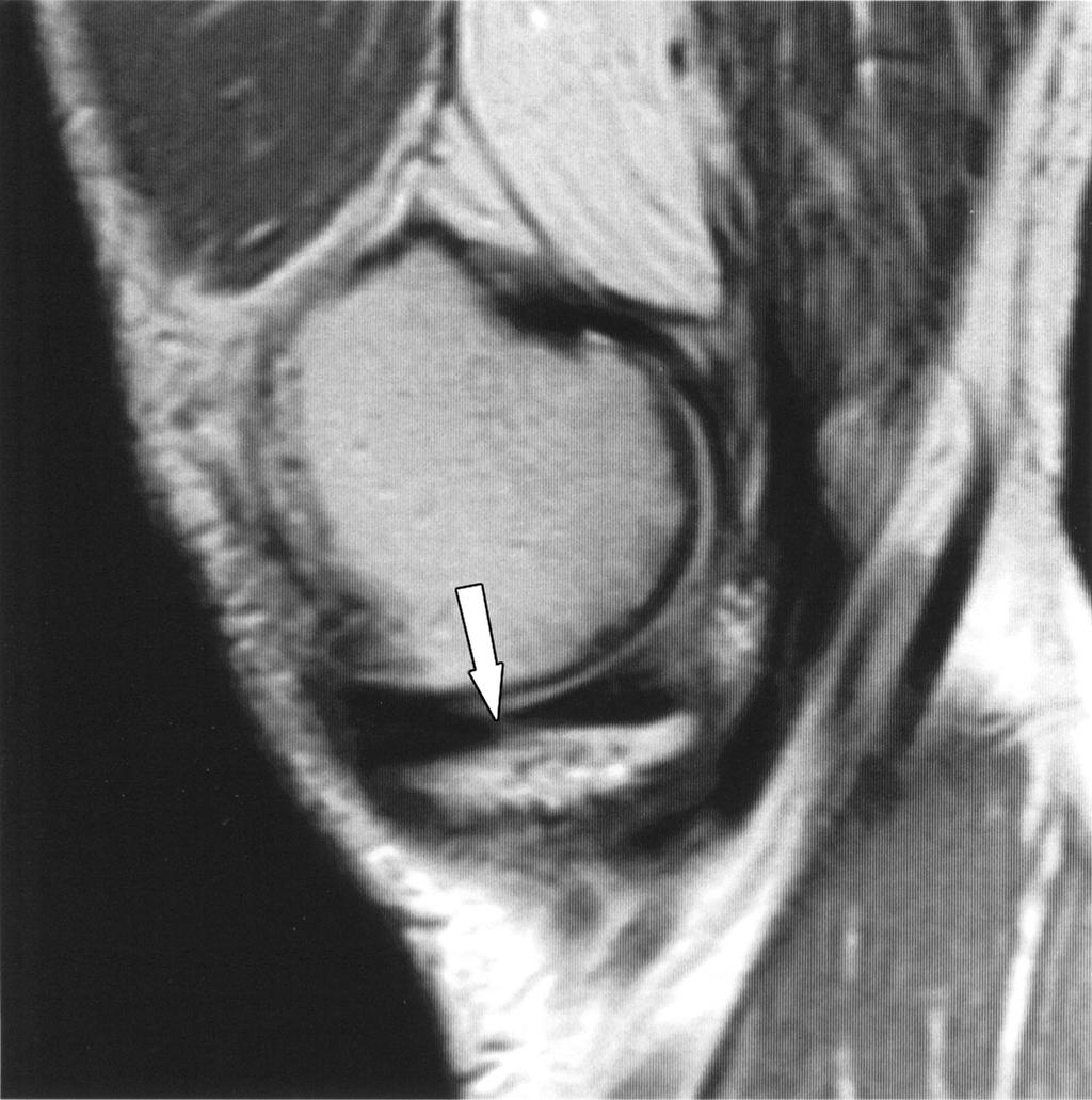 MRI of Meniscal Tears cerns regarding the study acquisition time.