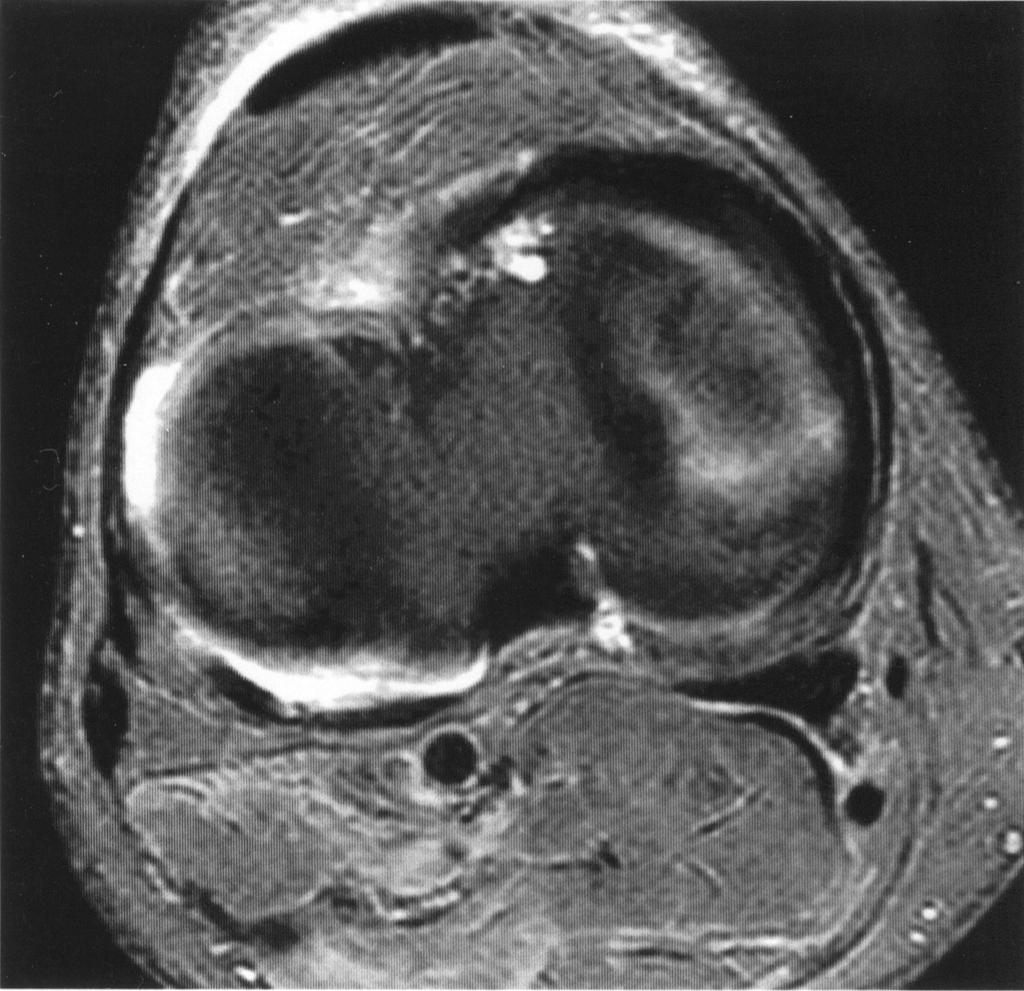 been found [1, 8 10]. Sensitivity and specificity ranged between % and 97% and % and 91% for the medial meniscus and between C D Fig. 3.