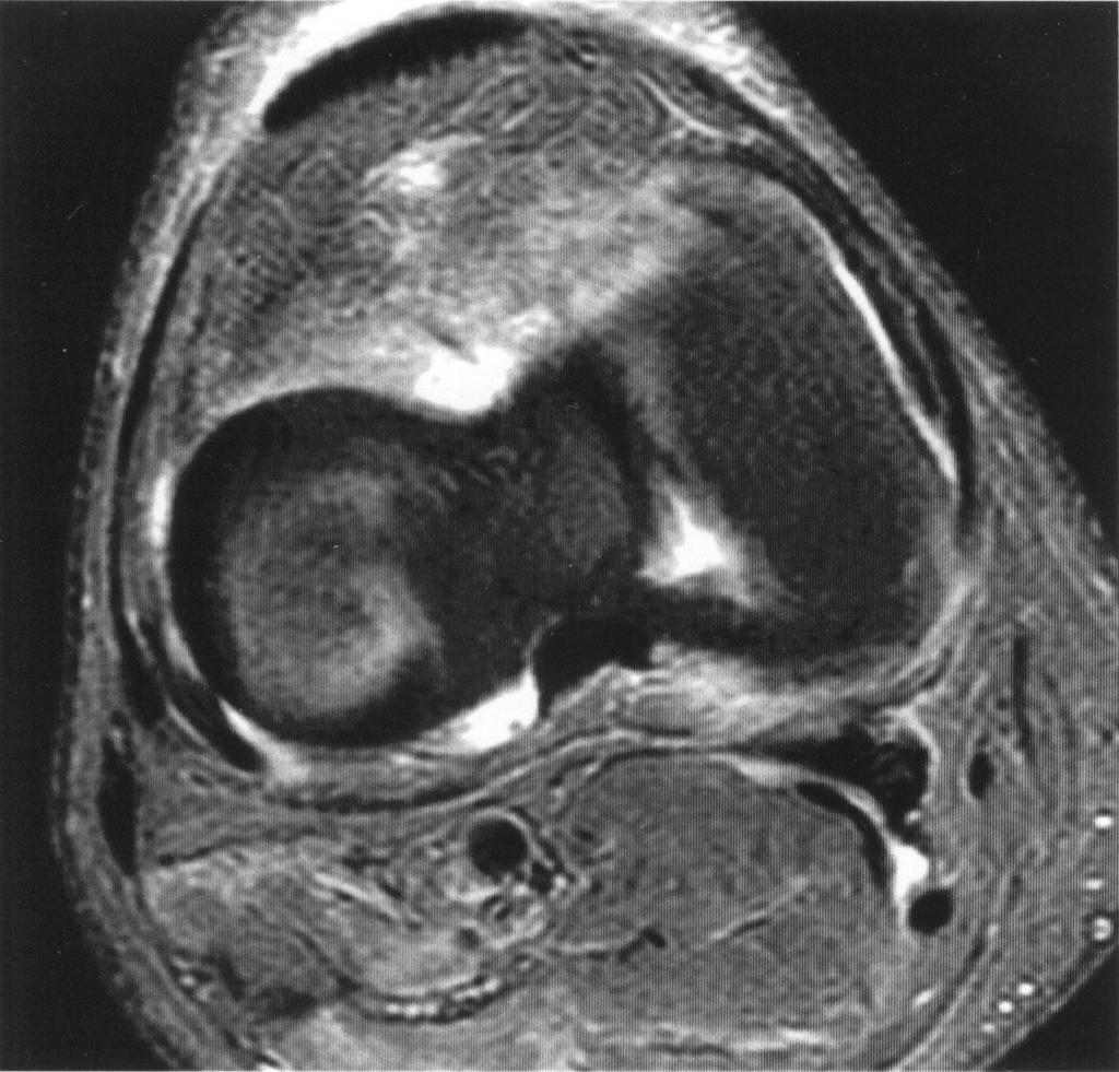 and, Sequential axial fat-saturated fast spin-echo proton density weighted images (TR/TE, 2,700/54; slice thickness, 4 mm) of right knee show medial and lateral