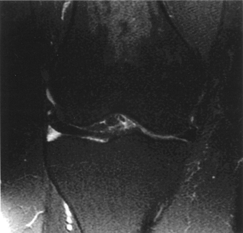 Tarhan et al. Fig. 4. 45-year-old woman with anterior cruciate ligament tear with false-positive interpretation of lateral meniscus tear.