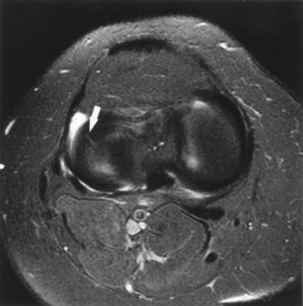meniscus thought to be tear., Coronal fat-saturated fast spin-echo proton density weighted image (3,750/60; slice thickness, 4 mm) shows meniscus is intact.