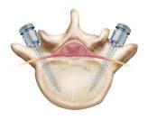 The screws are placed through each side of the vertebrae in the part of the bone called the pedicle (see Illustrations C and D).