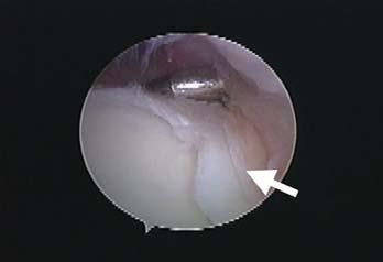 in IR deficits and may cause pathologic increases in internal rotator cuff contact and injury.