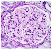 Renal biopsy LM: no obvious glomerular lesion DIF: negative for deposits (occasionally small amounts