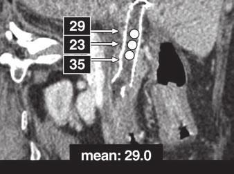 (B). C and D, Circles represent region-of-interest (ROI) markers used for measuring attenuation of suspicious lesions.