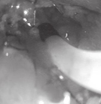 Measurements were performed three times, and average data were recorded. E, Side view duodenoscopy shows sludge in distal biliary stent.
