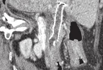 H, After basket extraction, cholangiogram shows no filling defects in biliary stent. the limits of artifactual pseudoenhancement [19].