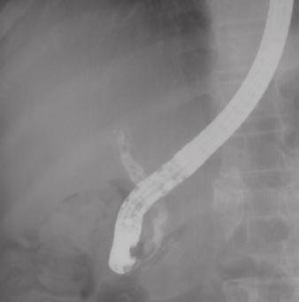 The other case may have been misdiagnosed because of the position of the biliary stent during the creation of curved planar reformation images.