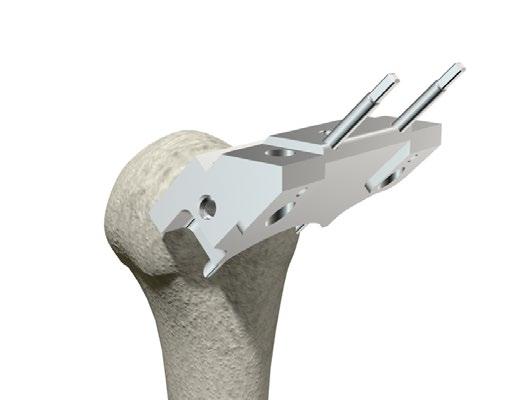 > With only the Superior Humeral Resection Block in place, drive the third and final cross pin into the Superior Humeral Resection Block to secure it in place prior to starting the humeral resection.
