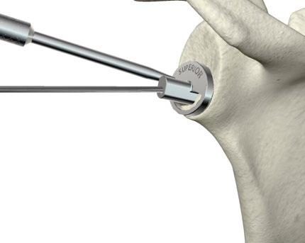 ReUnion RSA Reverse Shoulder Surgical Protocol Glenoid Preparation Placement of the Pilot Wire > Place the Glenoid Baseplate Centering Guide onto the face of the glenoid so that the inferior most