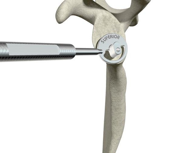 2mm Pilot Wire into the glenoid using the included pin driver or a pin collet at the desired position and depth, ensuring the pin engages the medial cortical wall. > Ideally, the 3.