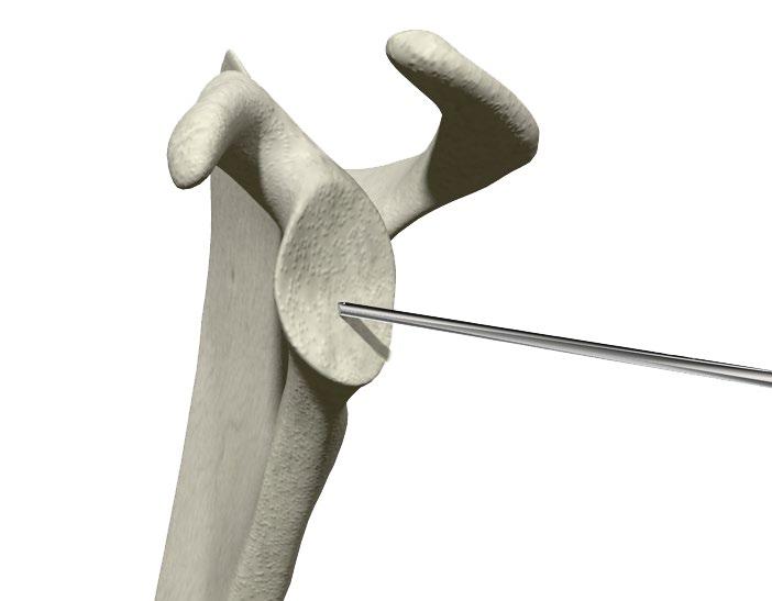 Reaming & Planing the Glenoid > Select the appropriately sized Glenoid Reamer/Planar and assemble it to the Cannulated Straight Reamer Driver via a hex shaped quick connect feature [Figure 17].