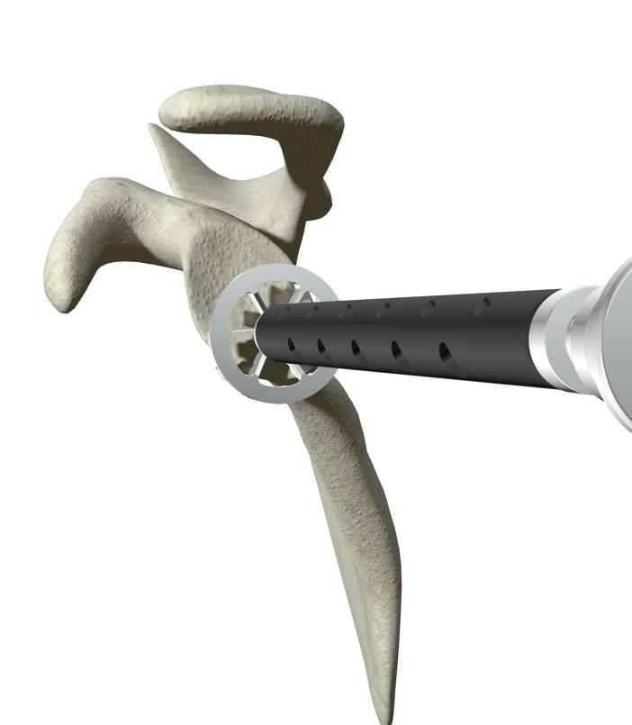 ReUnion RSA Reverse Shoulder Surgical Protocol > Pulse ream the glenoid to the desired level, ensuring that the medial geometry of the Glenoid Baseplate is completely reamed and contained inside the