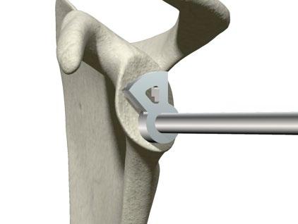 > It is critical that the glenoid is adequately reamed to ensure complete seating of the Glenoid Baseplate. Ream to expose subchondral bone.