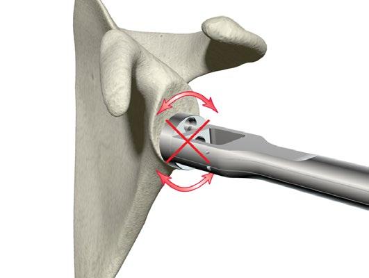 ReUnion RSA Reverse Shoulder Surgical Protocol > Apply an axial force towards the face of the glenoid [Figure 30] while holding the Baseplate Holder firmly in place to prevent rotation of the Glenoid