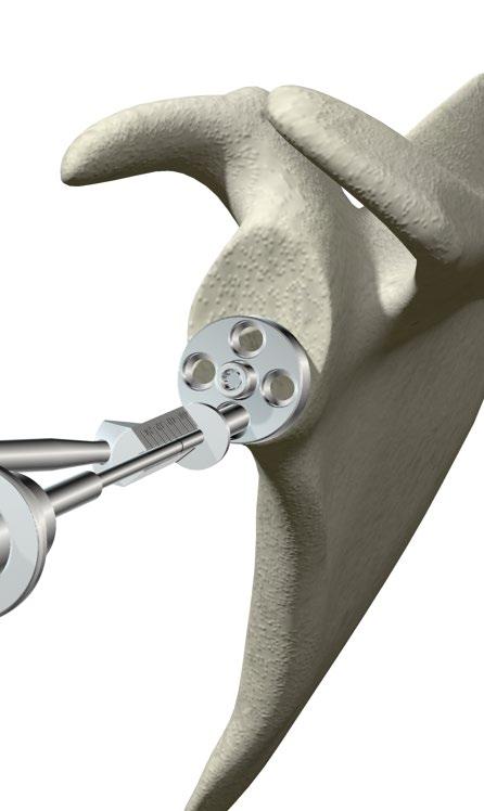 ReUnion RSA Reverse Shoulder Surgical Protocol Preparation for Peripheral Screw Placement Inferior Screw > Place the Variable Angle Peripheral Drill Guide into the Glenoid Baseplate s inferior hole.