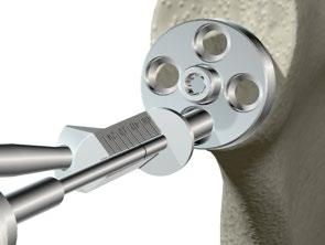 > Once the far cortex has been perforated take note of the depth by aligning the laser marked ring on the drill bit with the markings on the face of the guide [Figure 36].