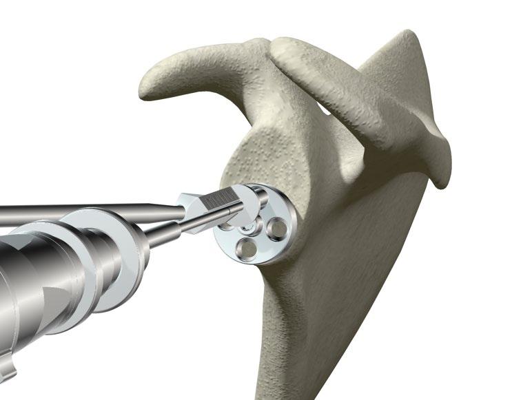 ReUnion RSA Reverse Shoulder Surgical Protocol Peripheral Screw Placement > The intent of Peripheral Screw placement should be to engage the maximum amount of good quality bone stock available with