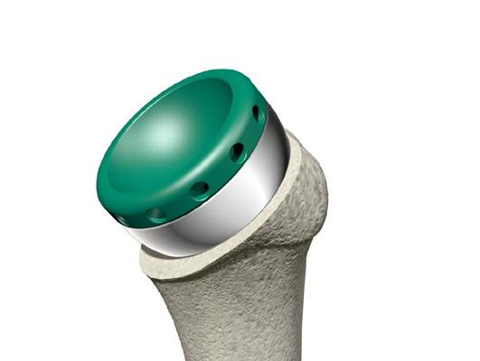 Traditional Humeral Trialing (Humeral Trial Insert & Humeral Cup Implant) Humeral Cup Trials Sizes 32, 36, and 40 Humeral Construct Size Range 8mm - 22mm (2mm incr.