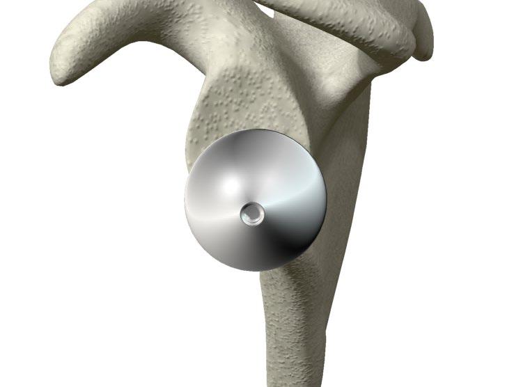 ReUnion RSA Reverse Shoulder Surgical Protocol Glenosphere Placement > Engage the desired definitive Glenosphere on the Glenosphere Holder/Impactor and place the Glenosphere onto the Glenoid