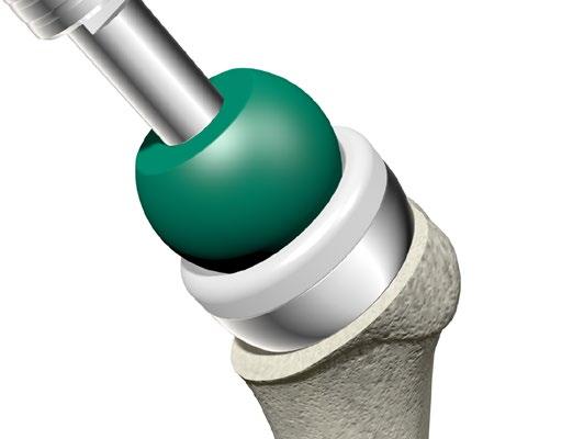 Humeral Cup & Insert Assembly Press-fit Stem Application > Place the definitive Humeral Cup implant into the Humeral Assembly Block.