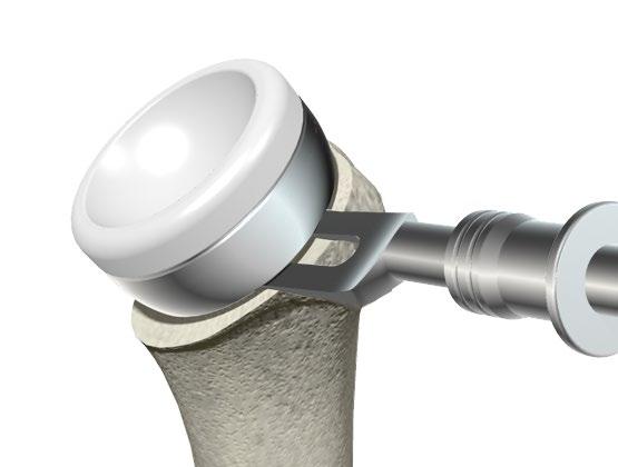 1mm drill bit to the flat bottom surface of the Humeral Cup away from the sides and the locking features of the X3 Humeral Insert.