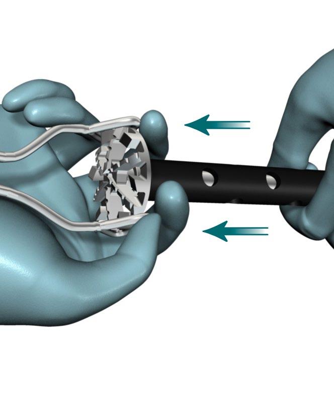 ReUnion RSA Reverse Shoulder Surgical Protocol Disassembly of Glenoid Reamer/Planar > The recommended method to disassemble the Glenoid Reamer/Planars from the Cannulated Straight