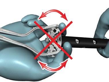 Figure 76 > By holding the reamer/planar face as shown [Figure 77] with the glenoid holder, pull the Glenoid Reamer/ Planar face away from Cannulated Straight Reamer Driver in an
