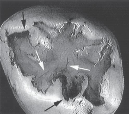 Fig 3a. Occlusal surface of specimen characteristic of group 3: acid primer resin light-cured after placement of sealant.