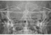 angle with open and closed occlusion with a slice position Sinus S1 maxillary