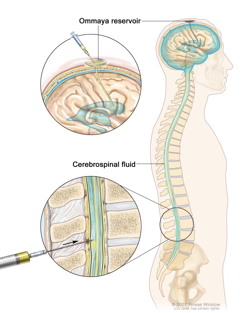 12 di 18 06/07/2016 14.53 Intrathecal chemotherapy. Anticancer drugs are injected into the intrathecal space, which is the space that holds the cerebrospinal fluid (CSF, shown in blue).