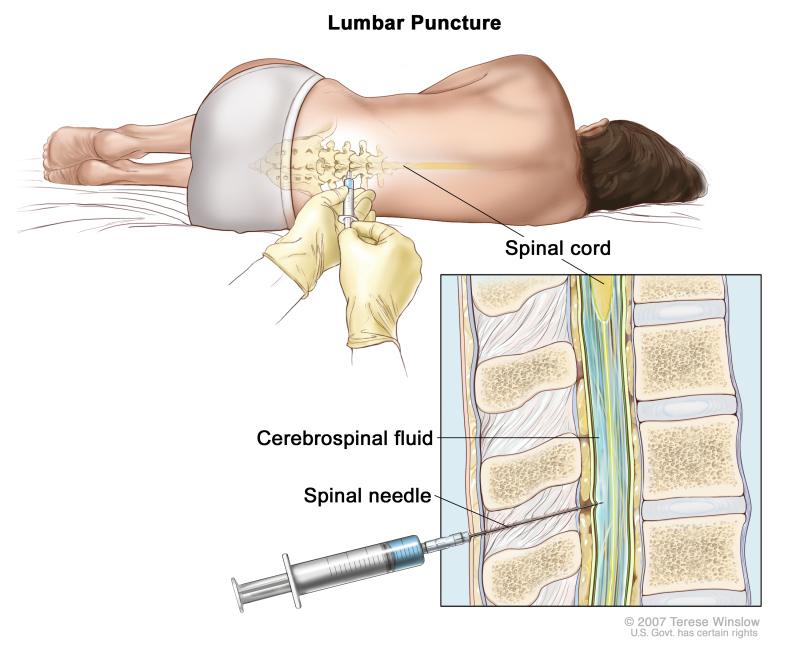 5 di 18 06/07/2016 14.53 Lumbar puncture. A patient lies in a curled position on a table.