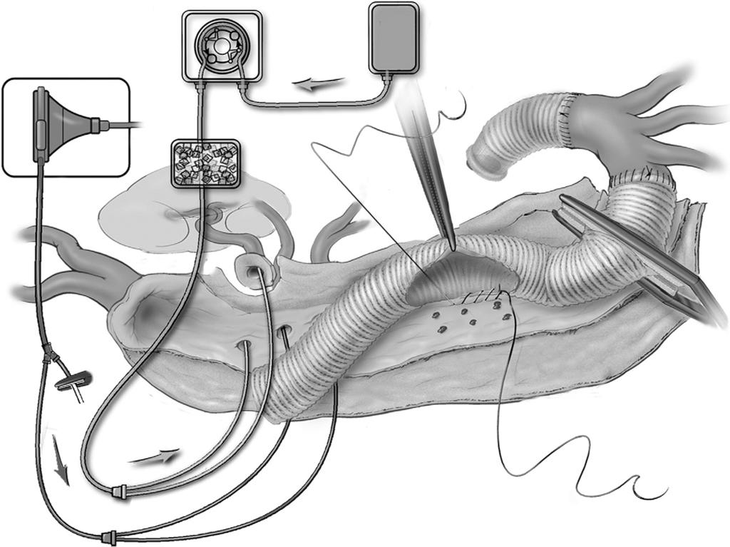 Thoracoabdominal aortic aneurysm repair: open technique 79 Figure 9 Once the origins of the visceral arteries are accessible, balloon catheters attached to the arterial limb of the left heart bypass