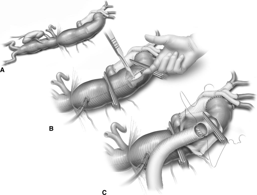 Thoracoabdominal aortic aneurysm repair: open technique 81 Figure 12 In staged repairs of extensive aneurysms involving the ascending aorta, aortic arch, and thoracoabdominal aorta, an elephant trunk
